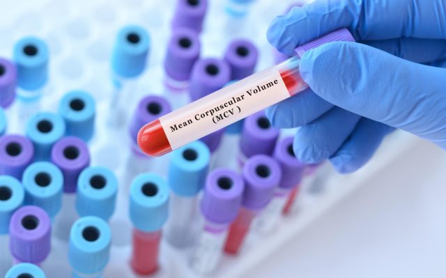 MCV در آزمایش خون چیست؟ بررسی MCV بالا و پایین و ارتباط آن با کم‌خونی