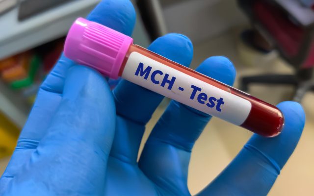 MCH در آزمایش خون چیست؟ علت پایین یا بالا بودن MCH
