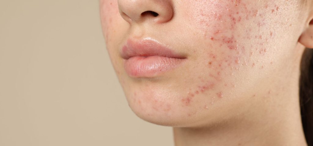 علت جوش صورت در سنین بالا چیست؟