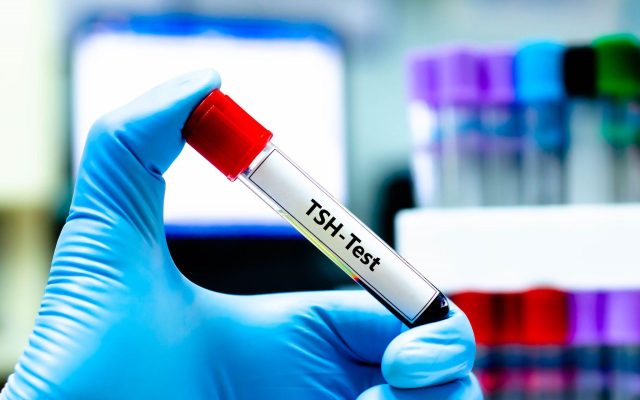 TSH در آزمایش خون چیست؟ تفسیر TSH بالا و پایین + محدوده طبیعی و ارتباط آن با تیروئید