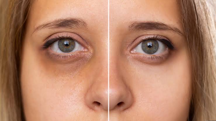 سیاهی دور چشم؛ علت تیرگی زیر چشم چیست؟
