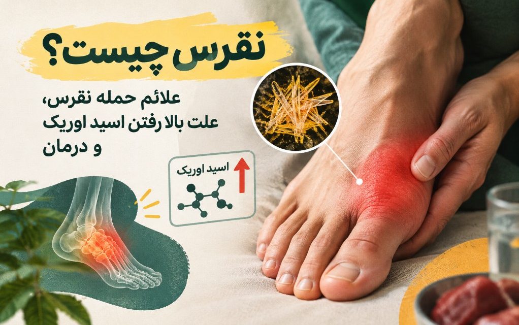نقرس چیست؟ علائم حمله نقرس، علت بالا رفتن اسید اوریک + درمان