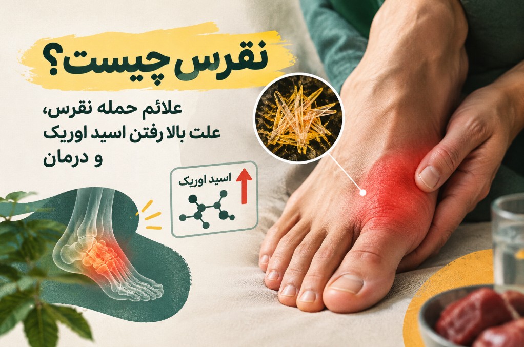 نقرس چیست؟ علائم حمله نقرس، علت بالا رفتن اسید اوریک + درمان